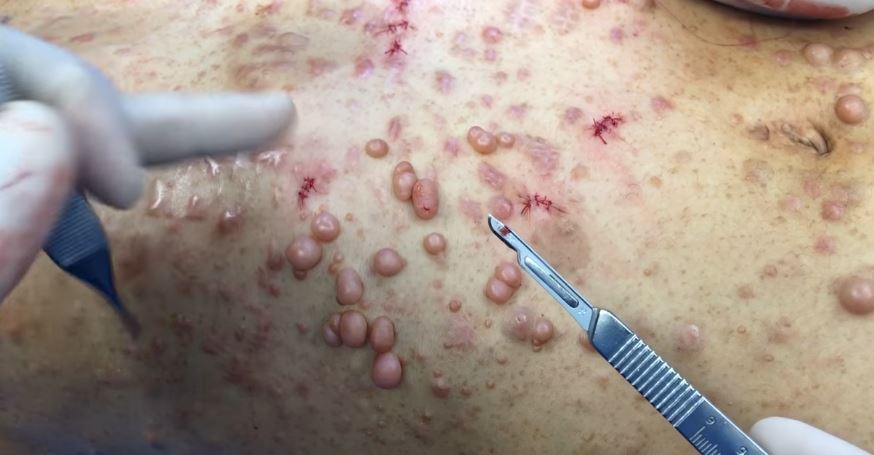 Von Recklinghausen's Disease